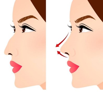 اهداف جراحی بینی 