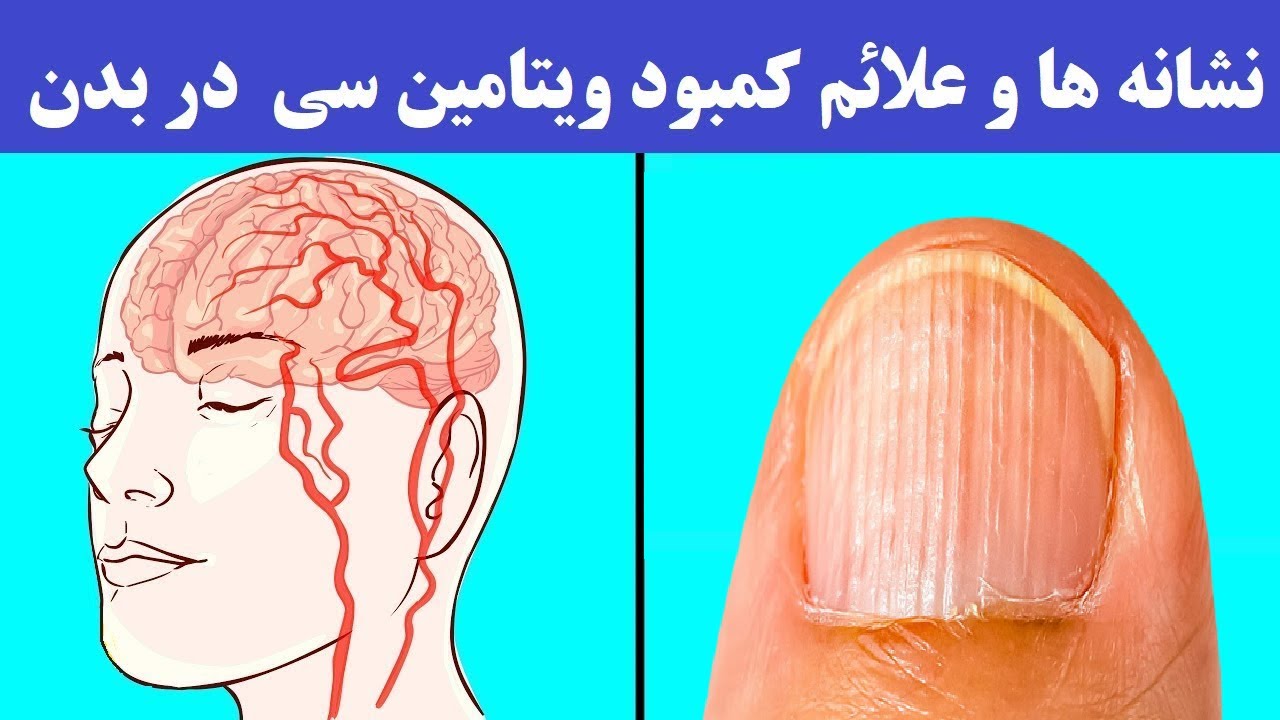 کمبود ویتامین C چه علائم و نشانه هایی دارد